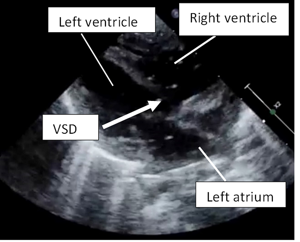 Bedside-cardiac-ultrasound-(parasternal-long-axis)-demonstrating-air-embolism-(bright-dots)-going-across-the-moderate-ventricular-septal-defect-(VSD).