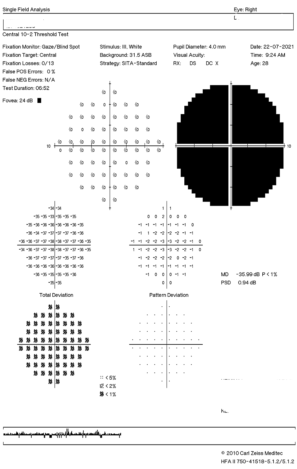 Humphrey-Visual-Field-10-2 testing of-the-right-eye-showed-generalized-depression