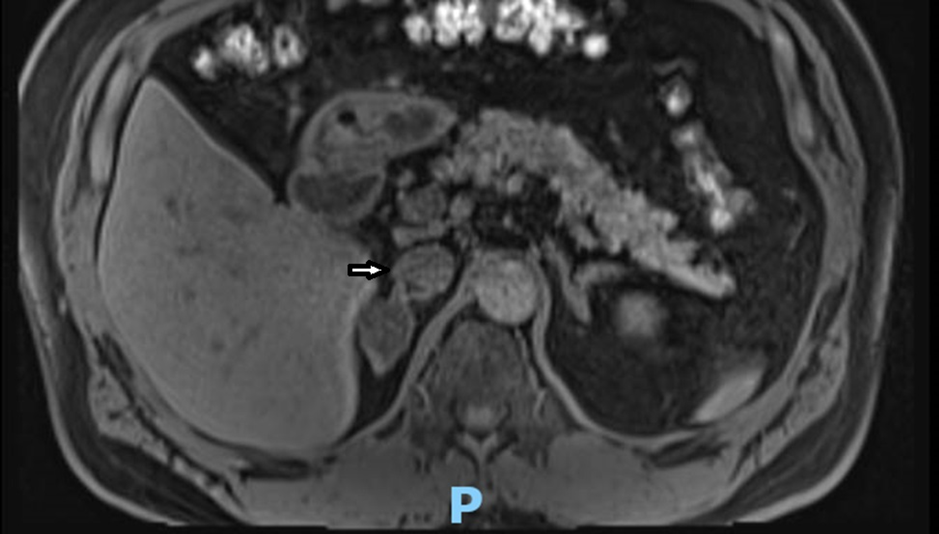 Cureus Pursuing Investigations Establish The Challenging Diagnosis Of Primary Aldosteronism