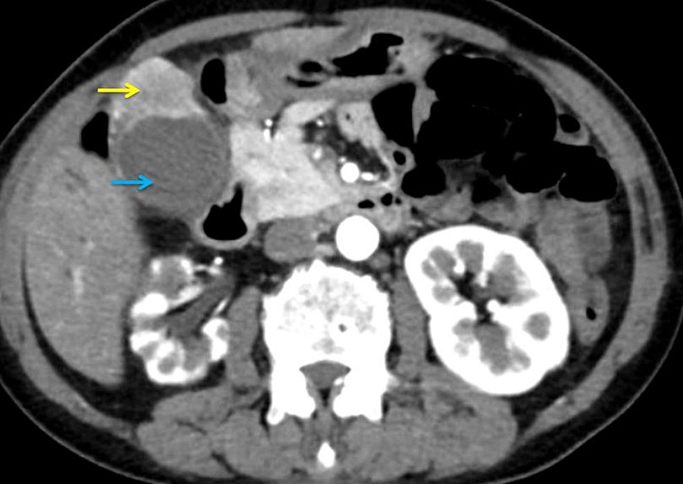 cureus-small-cell-carcinoma-of-gallbladder-with-nodal-metastasis