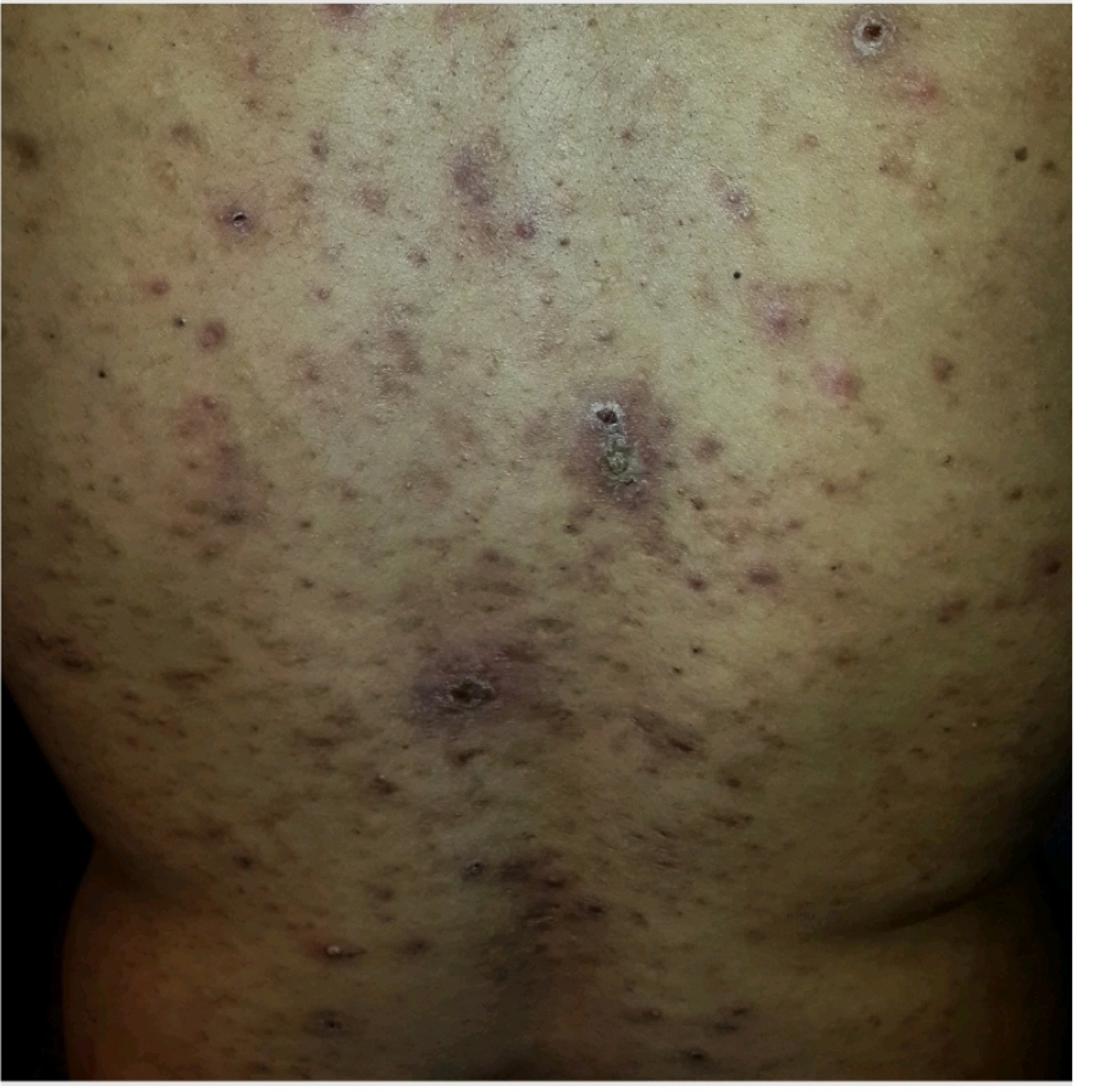 Cureus | Trichophyton rubrum Skin Folliculitis in Behçet's Disease | Article