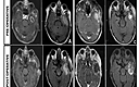 Cureus | Rapid Interval Recurrence Of Glioblastoma Following Gross ...