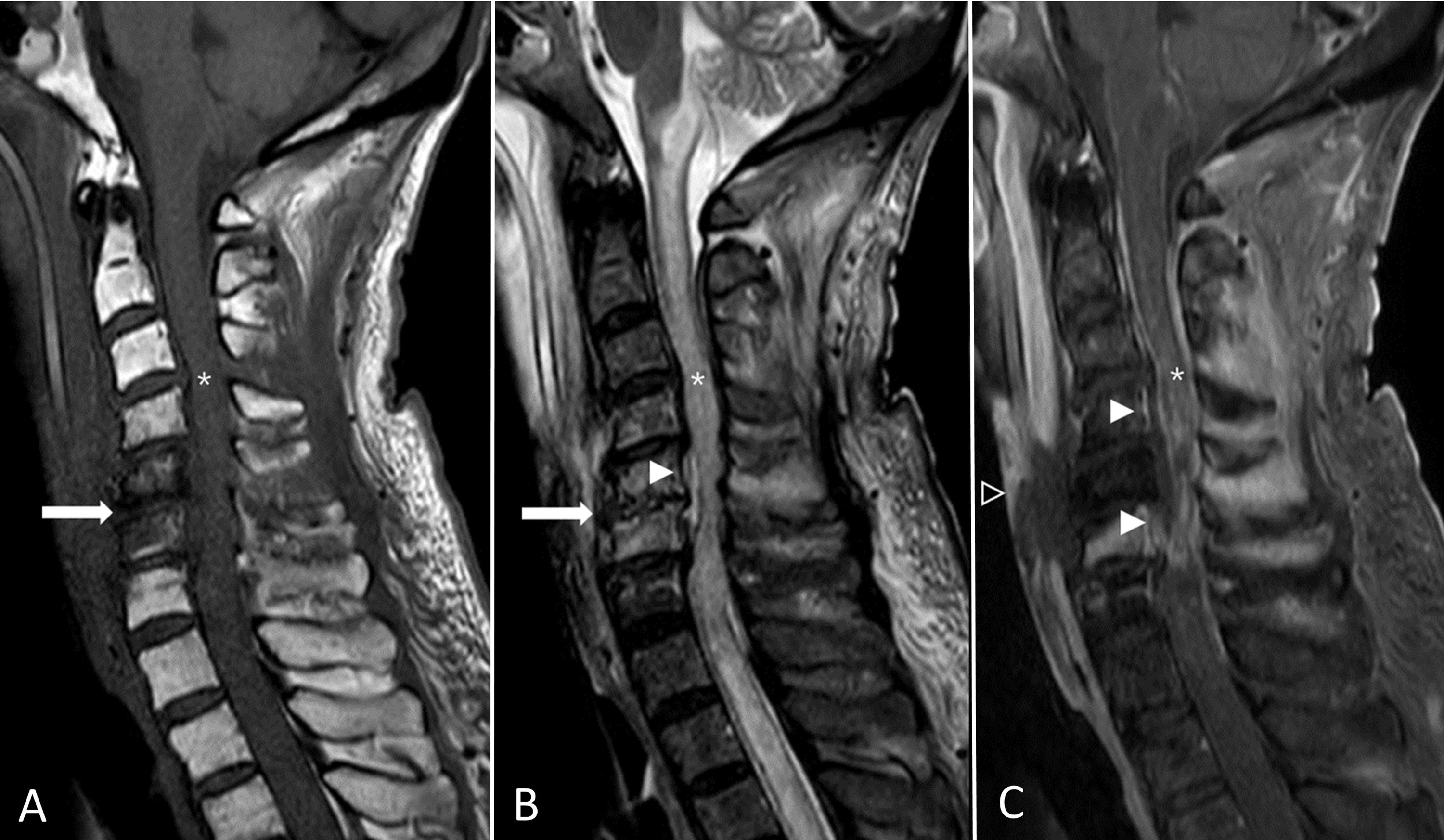 Cureus | Fatal Cervical Spinal Epidural Abscess and Spondylodiscitis ...