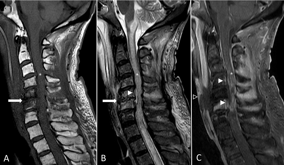 Cureus | fatal cervical spinal epidural abscess and spondylodiscitis