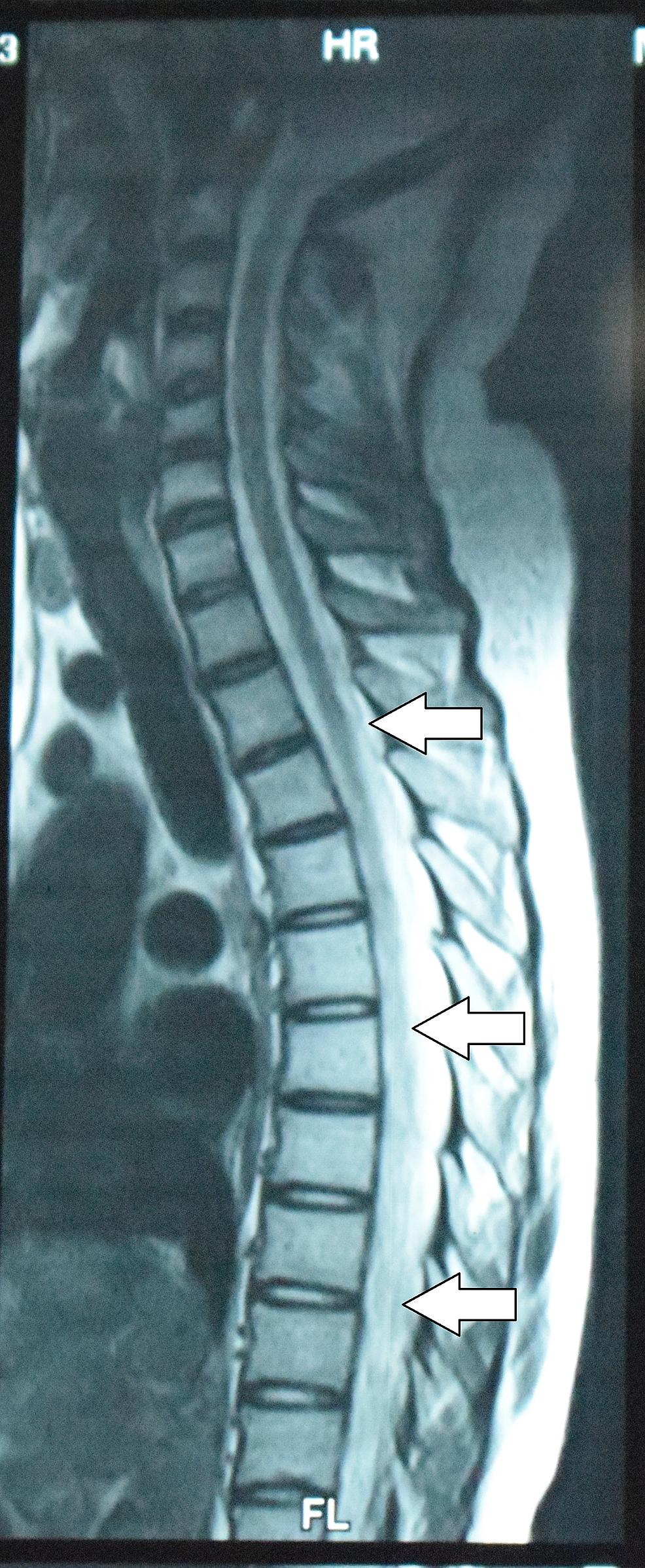 Cureus Systemic Lupus Erythematosus Presenting As Longitudinally Extensive Transverse Myelitis And Nephritis A Case Report