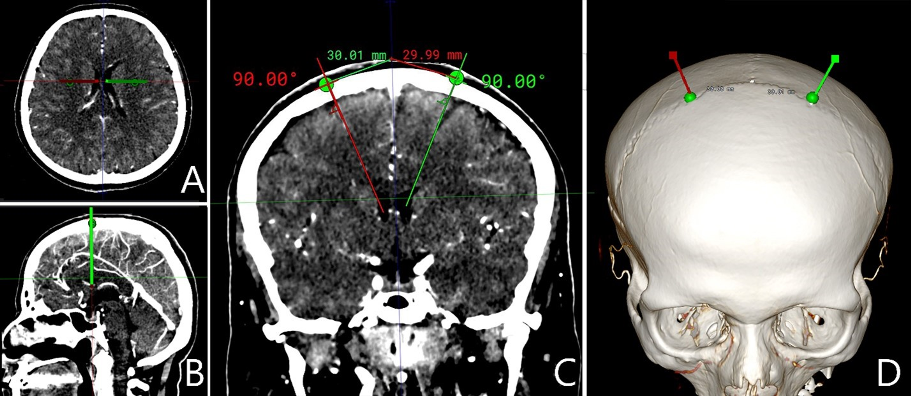 Cureus | Analysis of a Novel Entry Point for Freehand Ventriculostomy Using  Computerized Tomography Scans