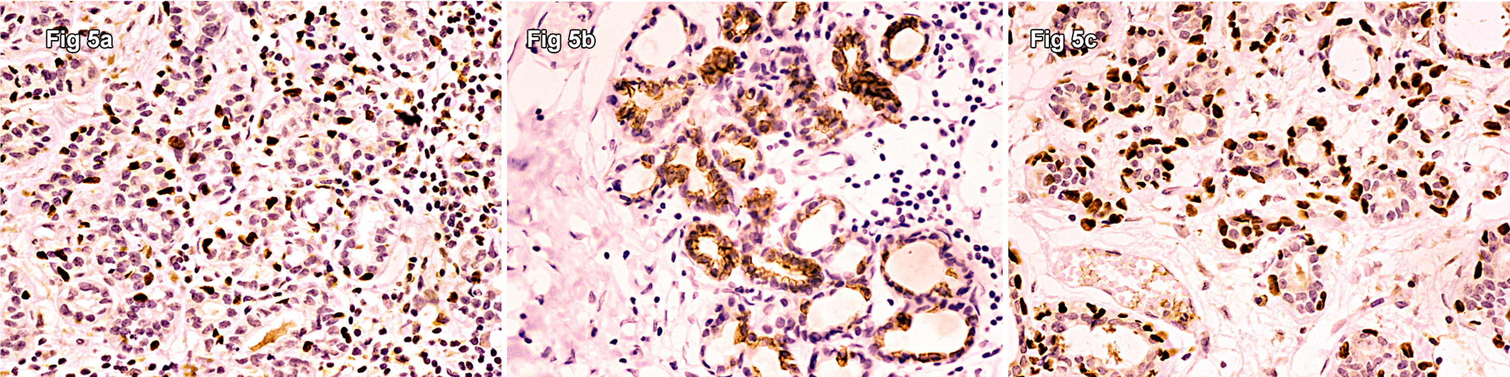 Cureus Syringomatous Adenoma Of The Nipple In A Male Breast A Case Report With A Brief Review Of Literature And Histomorphological Approach To Diagnosis