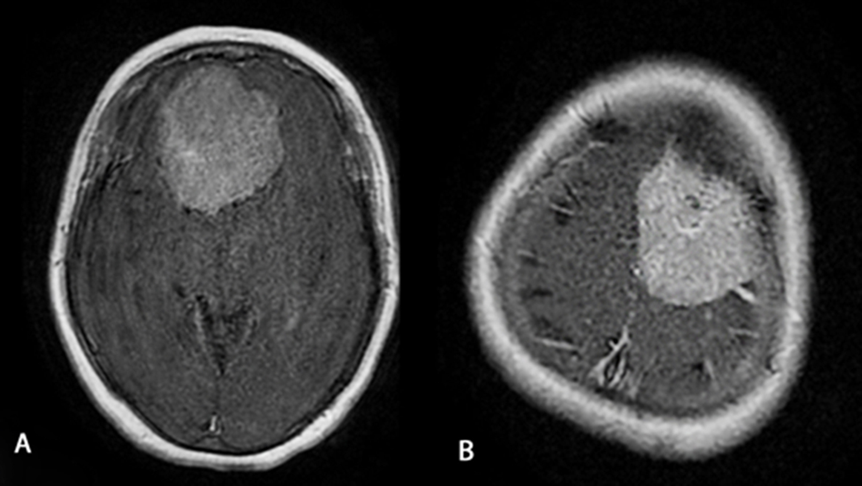 Cureus | Retrospective Analysis and Comparison of 48 Intracranial ...