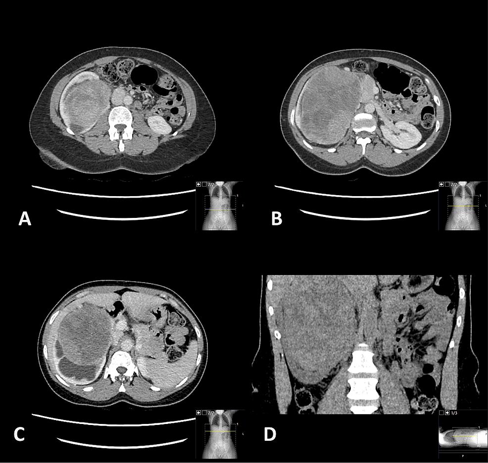 Cureus | A Rare Case of a Large Primary Renal Neuroendocrine Tumour: A ...