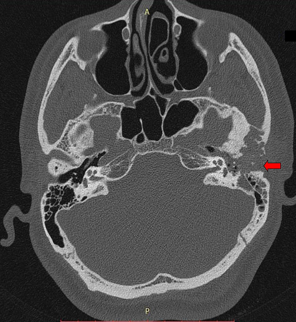 external auditory canal