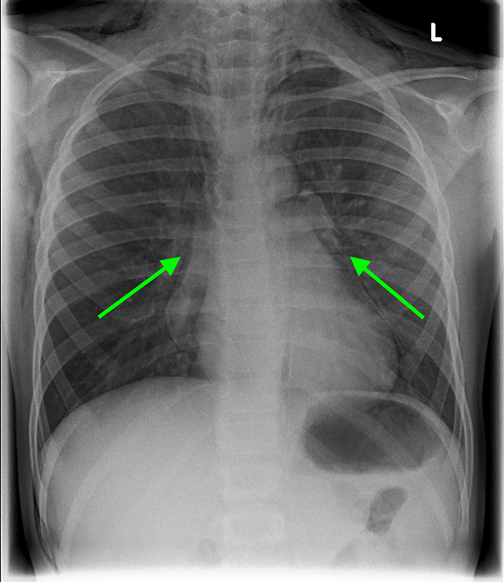 Cureus Paediatric Longitudinal Tracheal Laceration From Blunt Force