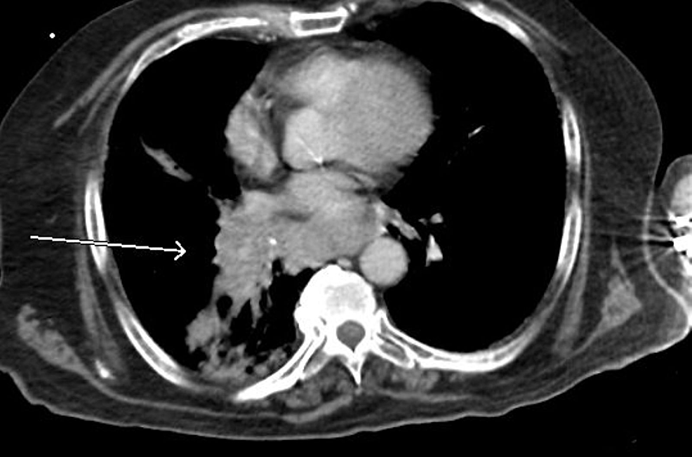 Cureus Isolated Myeloid Sarcoma A Diagnostic Dilemma 4087