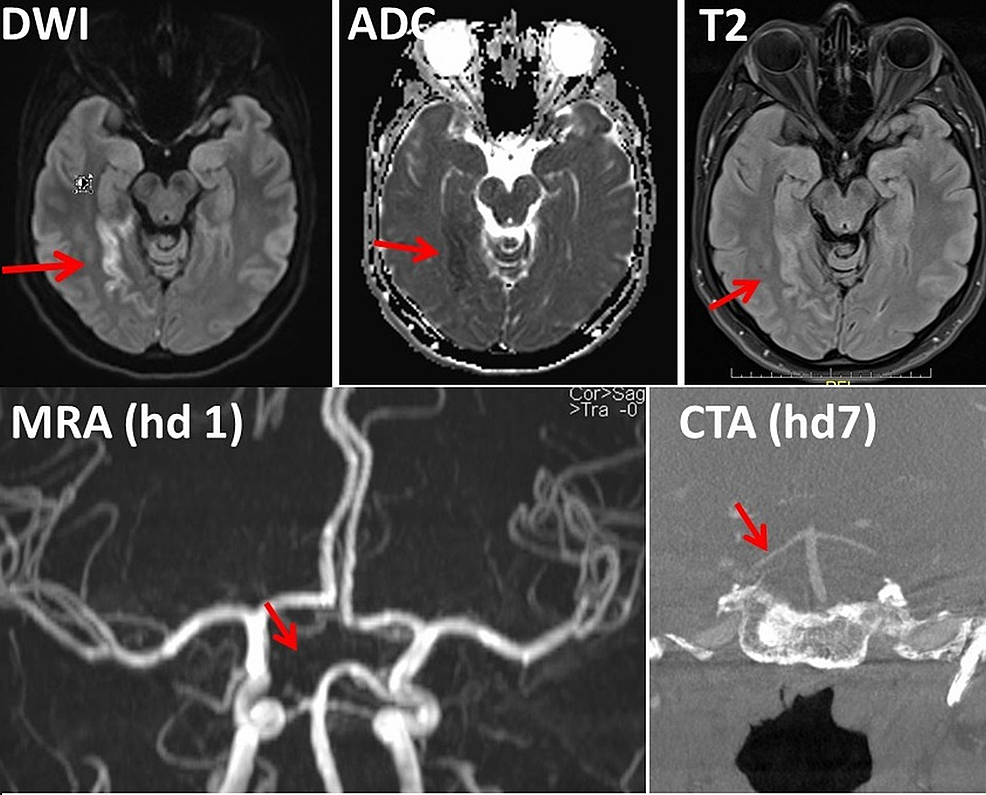 Cerebral-MRI-and-CT-angiography-of-the-index-patient.