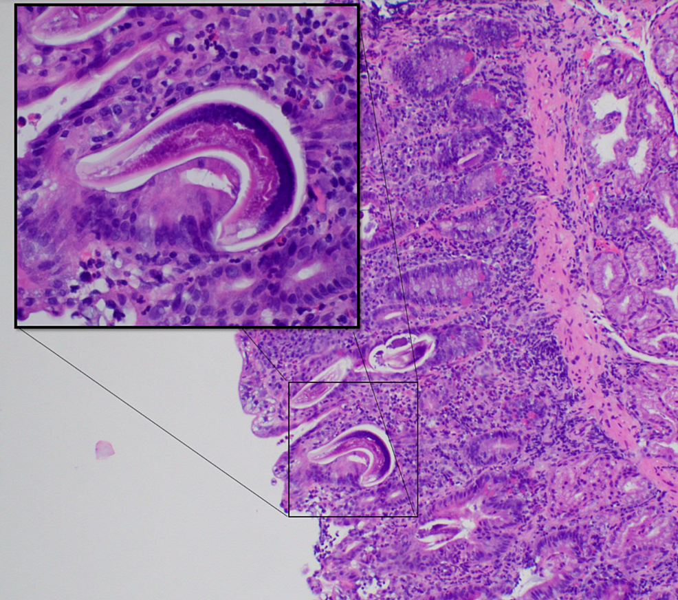 Duodenal-mucosa-with-acute-inflammation,-reactive-changes,-and-parasitic-organisms,-which-was-found-to-be-Strongyloides-stercoralis.