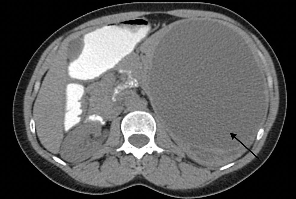 Abdominal-CT-scan-illustrating-the-cystic-mass-with-several-posterior-loculations