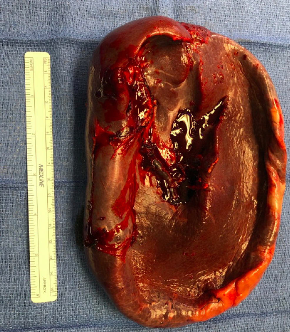 Gross-pathology-of-the-enlarged-spleen