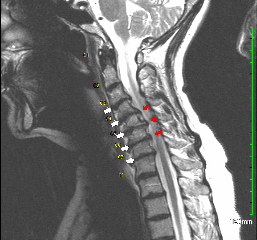 Cervical Spine Fusion C3-C5 ACDF