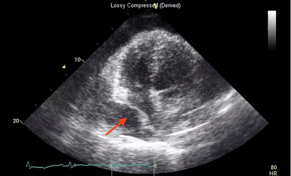 Apical-four-chambers-view-of-ventricular-systolic-demonstrating-right-atrial-collapse-(arrow)