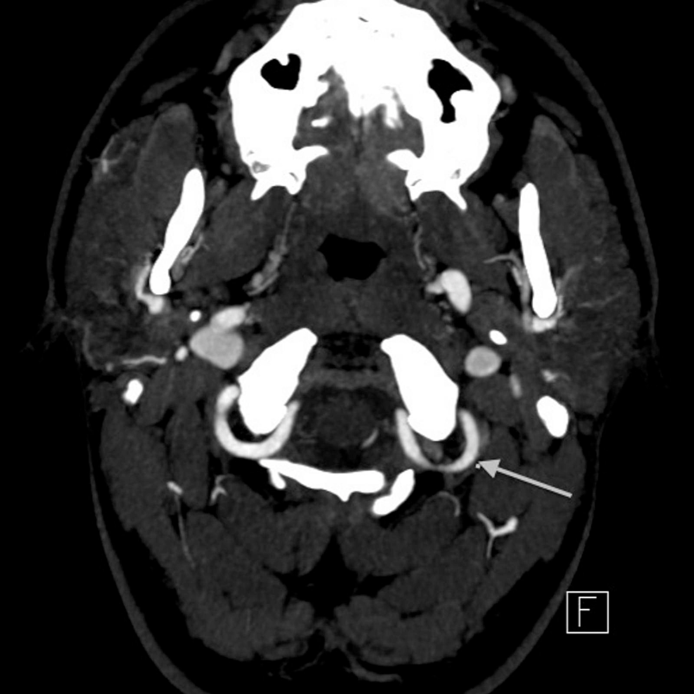 Cureus, Sequelae of a Rare Case of Penetrating Parotid Gland Injury:  Ultrasound and Magnetic Resonance Imaging Features