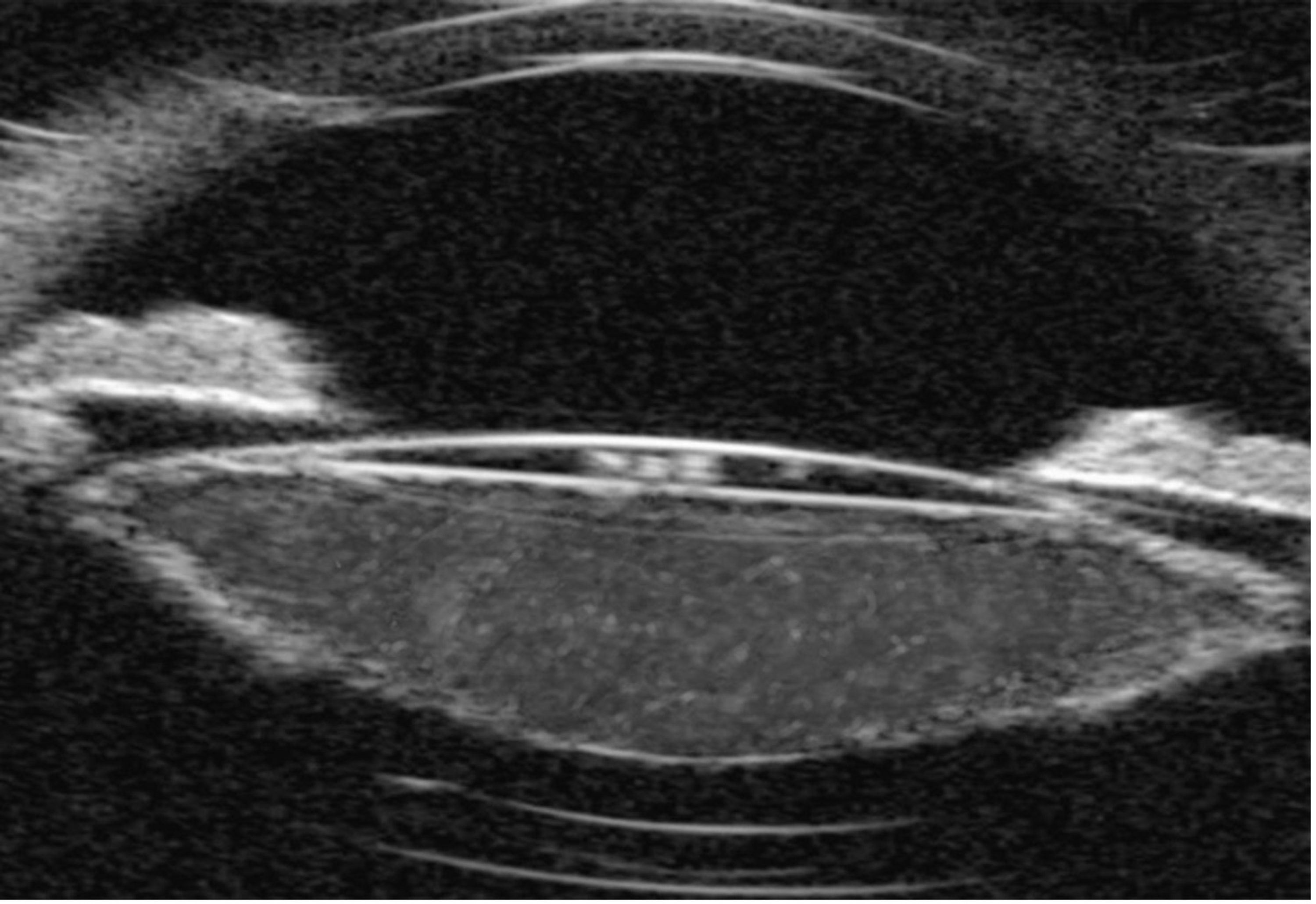Cureus Unusual Late Presentation of Capsular Bag Distension Syndrome Associated With