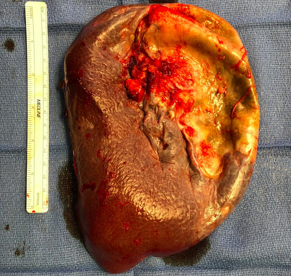 Gross-pathology-of-the-spleen-with-the-decompressed-splenic-cyst