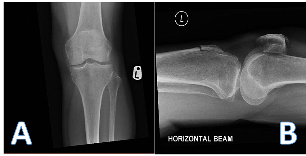 Pre-operative-anterior-posterior-(A)-and-lateral-(B)-radiographs-taken-in-the-emergency-department.