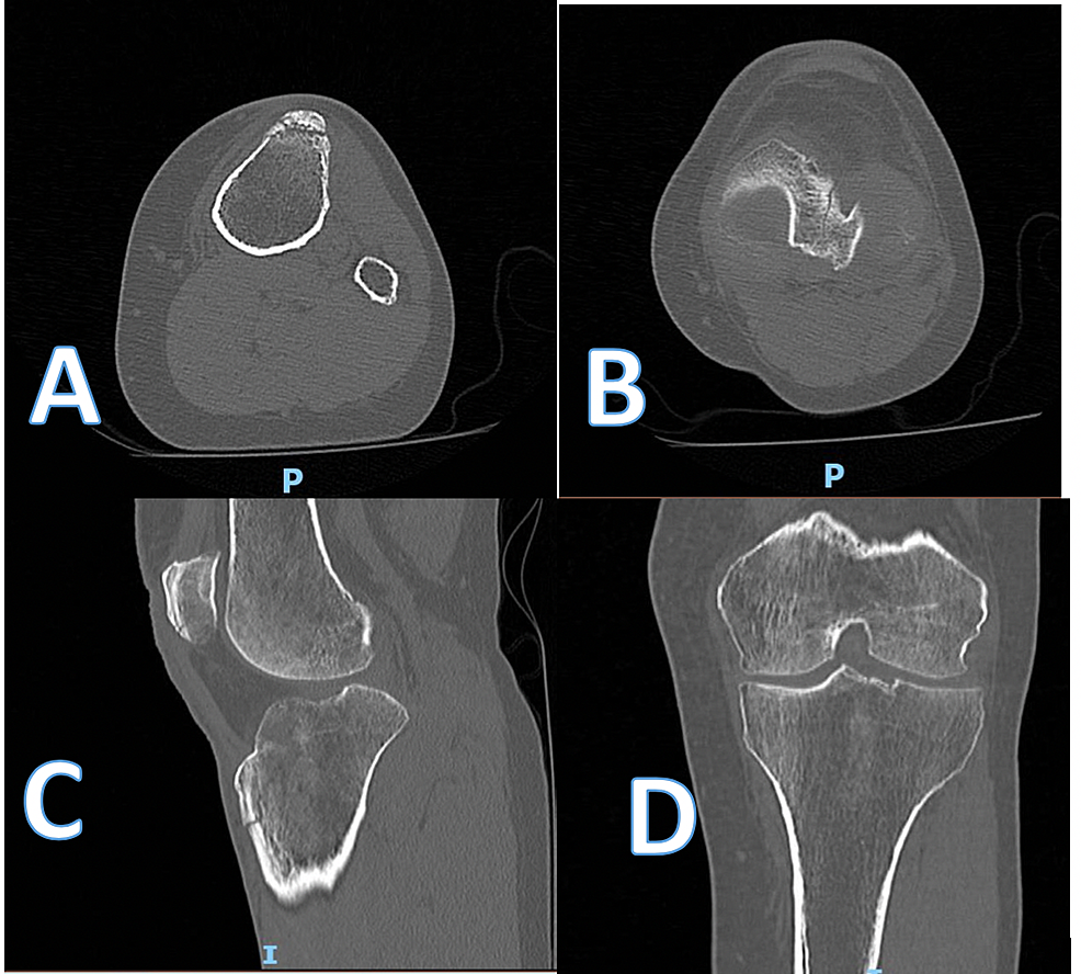 Axial-(A,B),-sagittal-(C)-and-coronal-(D)-images-of-pre-operative-CT-scan-of-the-left-knee.