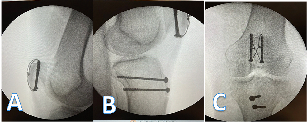 Lateral-(A,B)-and-anterior-posterior-(C)-radiographs-taken-intra-operatively.