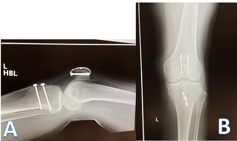 Lateral-(A)-and-anterior-posterior-(B)-radiographs-taken-six-weeks-post-operation.
