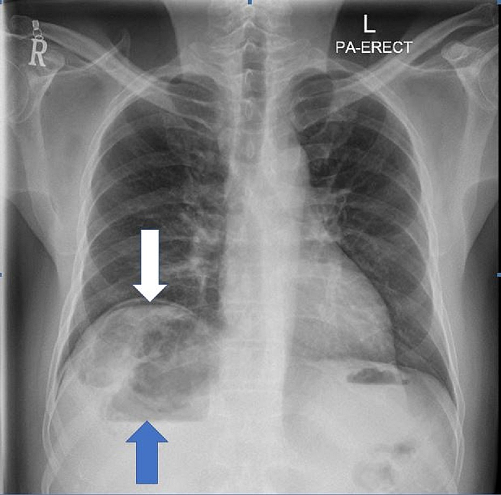 Cureus Gas Under Diaphragm A Rare Case Of Ruptured Liver Abscess 