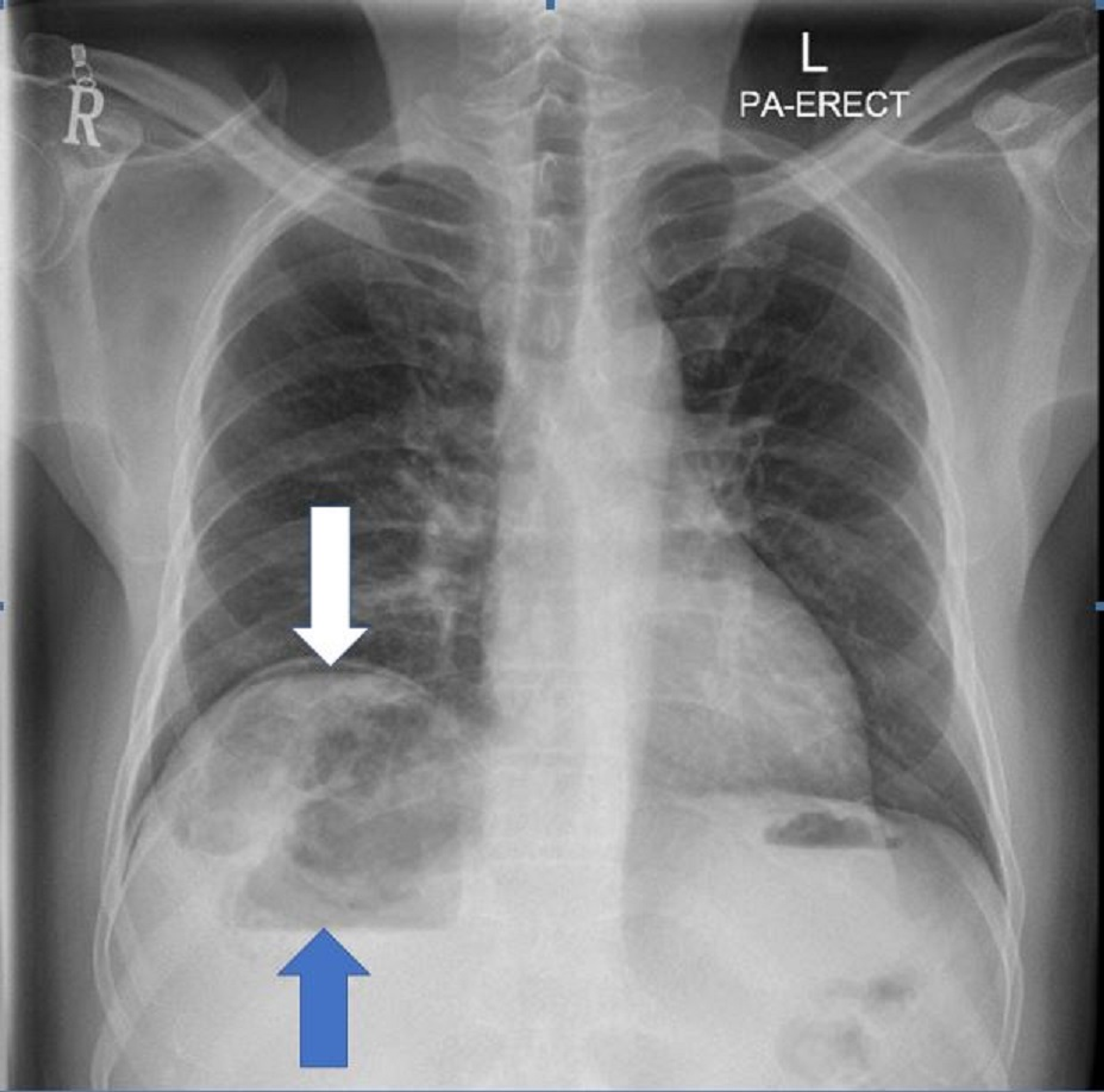 Cureus | Gas Under Diaphragm: A Rare Case of Ruptured Liver Abscess ...