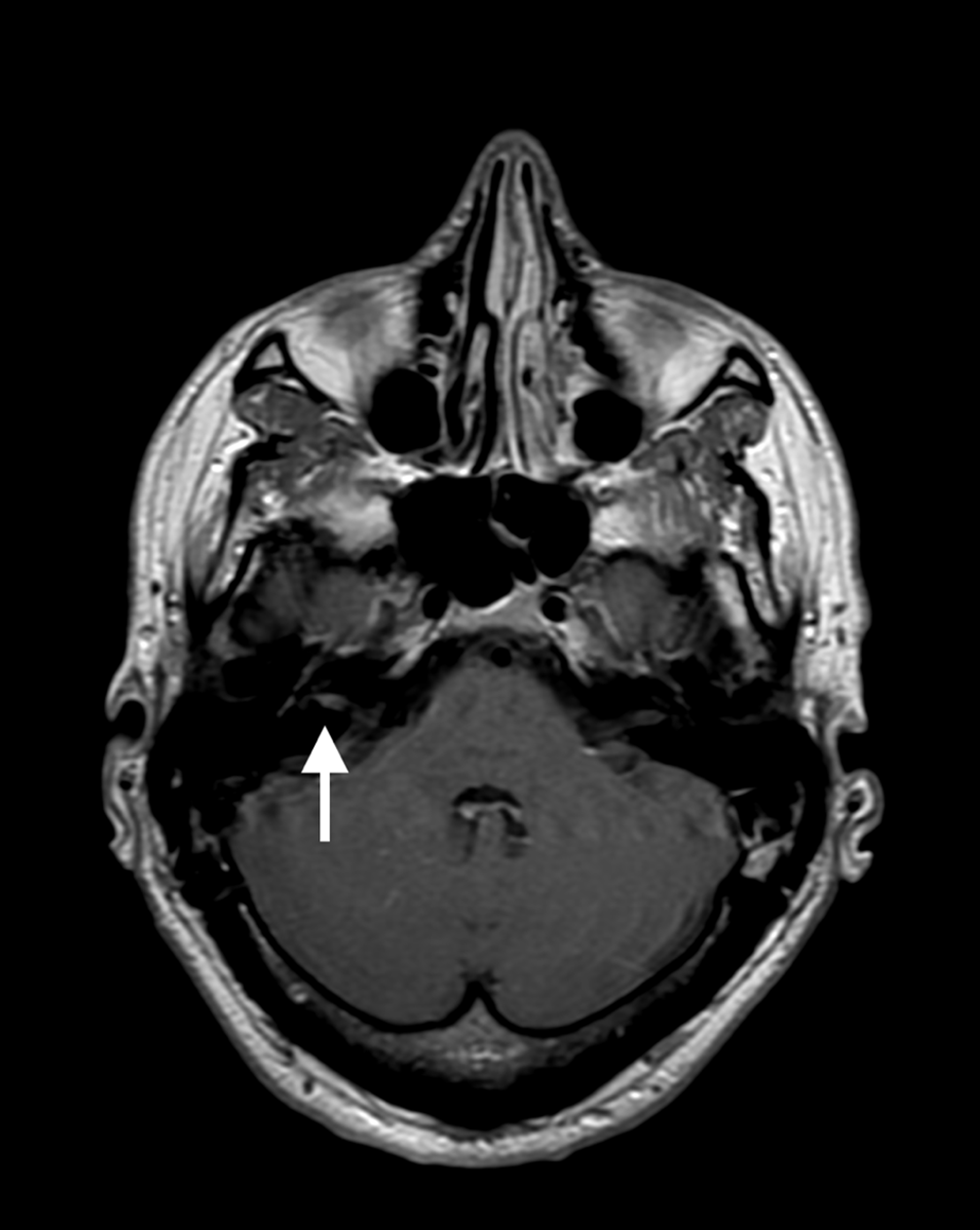 Cureus A Detailed Account Of Severe Bells Palsy An Autobiographical Case Report