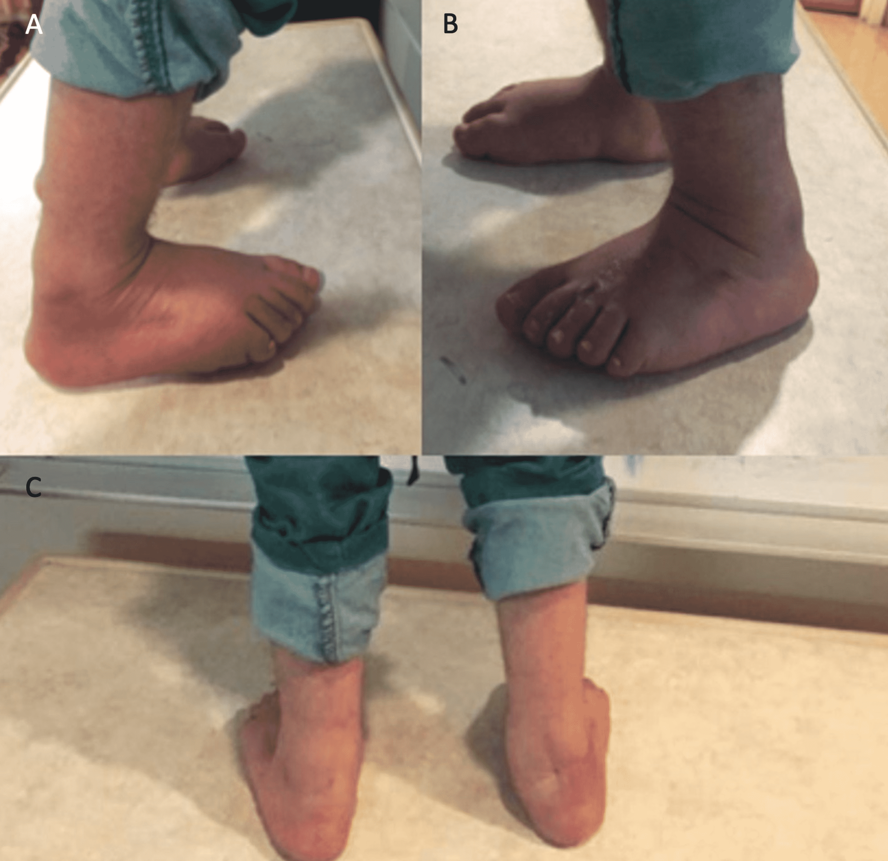 Cureus Targeted Minimally Invasive Percutaneous Posteromedial Release Of Residual Clubfoot In Myelomeningocele Patients A Report Of Two Cases