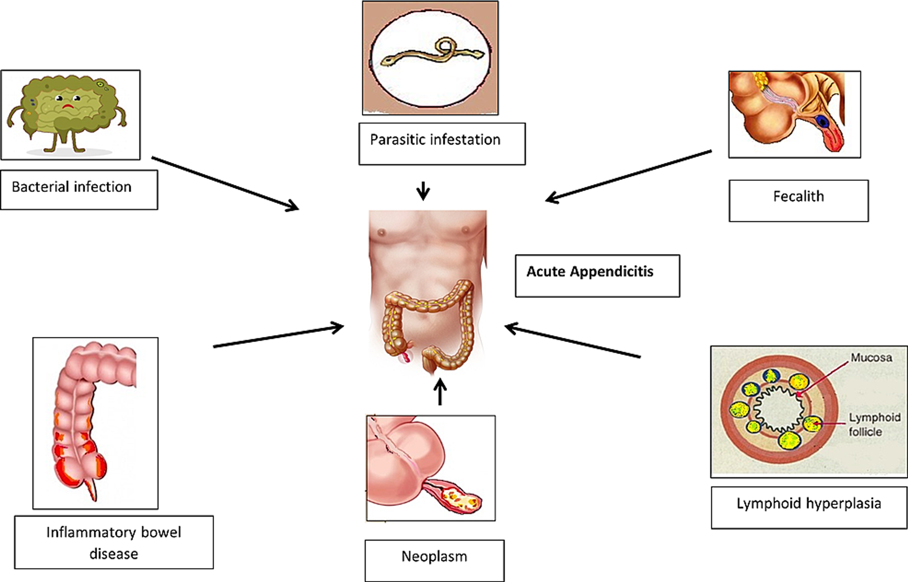 acute-appendicitis-icd-10