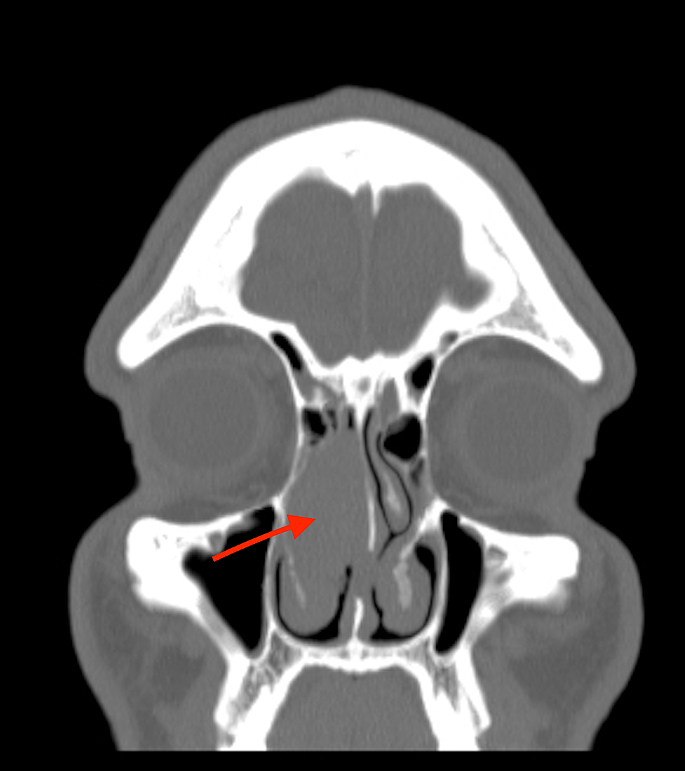 A Case Of Solitary Fibrous Tumour Arising From The Anterior Skull Base 