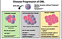 The Progression Of Chronic Myeloid Leukemia To Myeloid Sarcoma: A ...