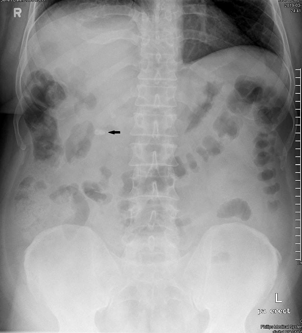 Cureus | Successful Surgical Management of Unusual Gallbladder Anatomy ...