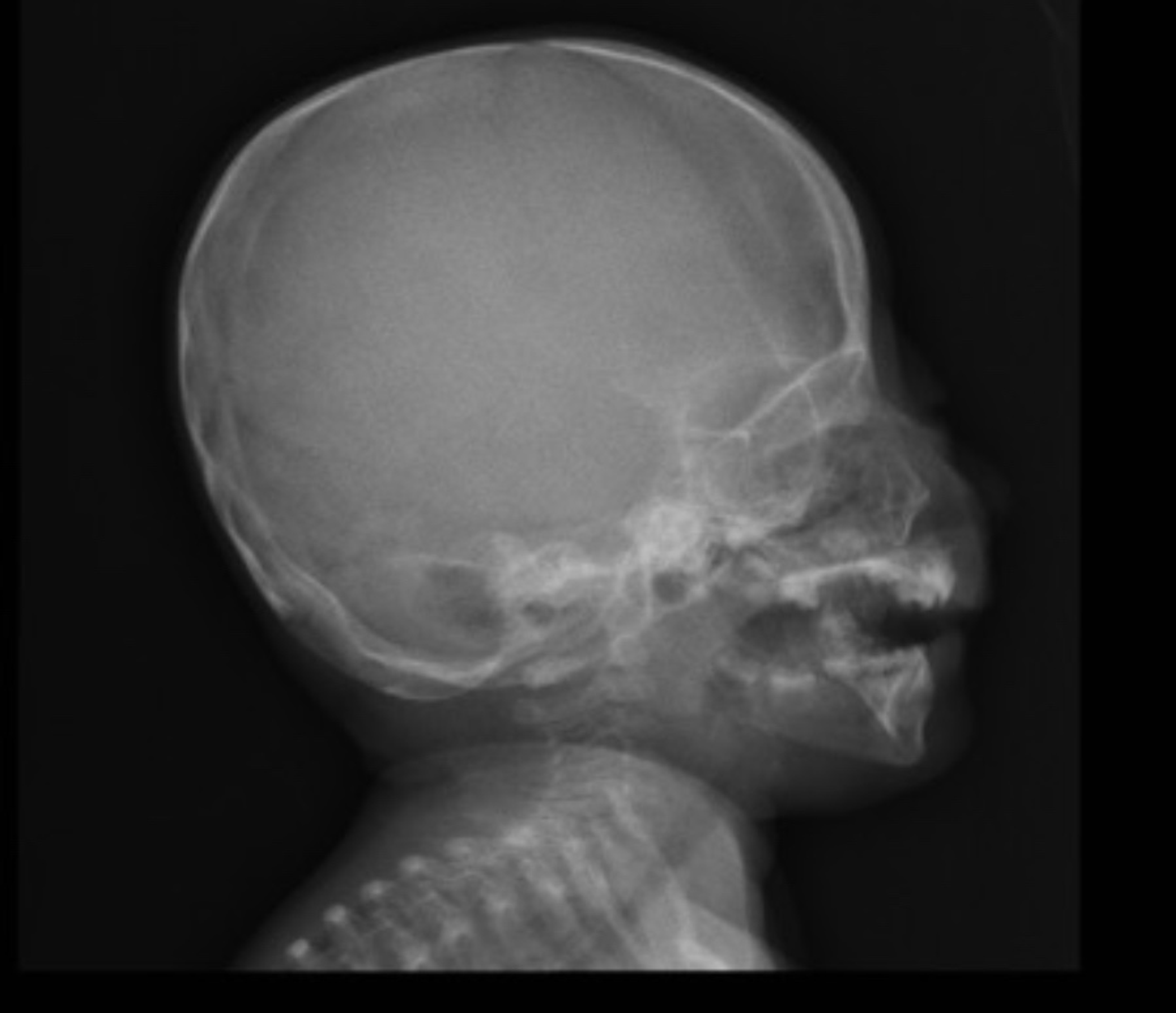 Cureus | Microcephalic Osteodysplastic Primordial Dwarfism Type II With ...