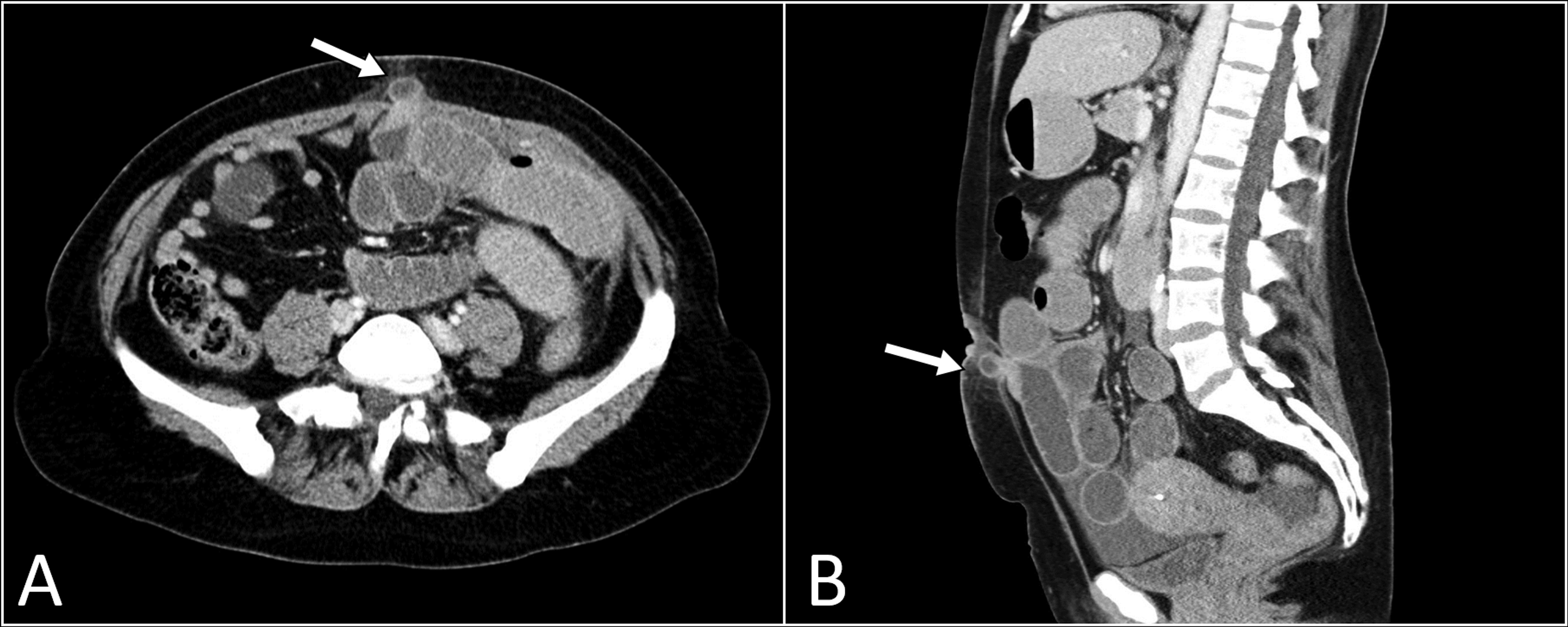 Cureus | Laparoscopic Port Site Hernia: A Rare Etiology of Intestinal ...