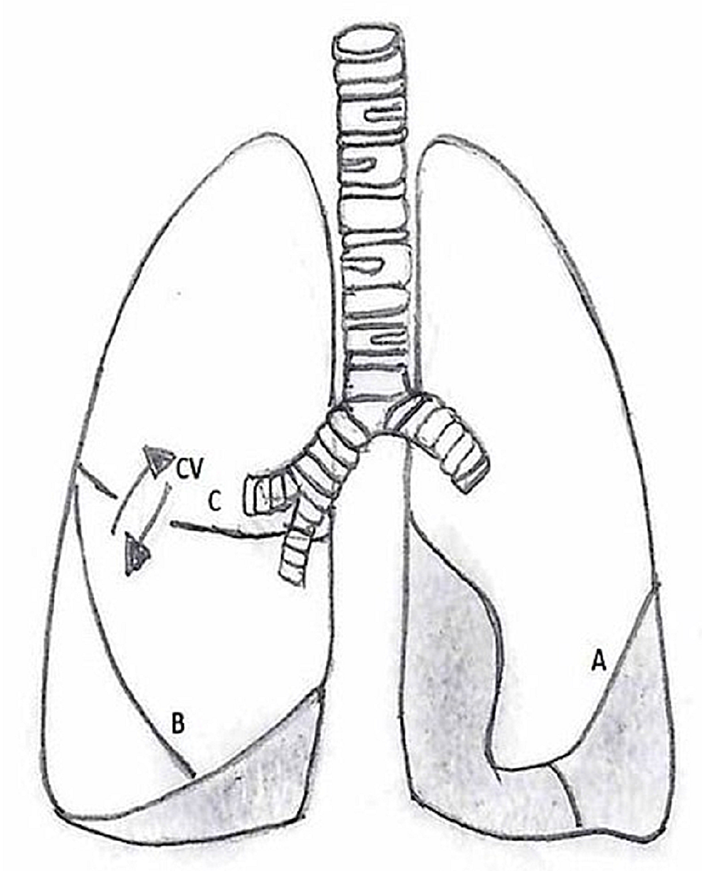 Line-diagram-showing-fissures-of-the-lungs-with-collateral-ventilation-in-the-right-lung:-(A)-Left-oblique-fissure,-(B)-right-oblique-fissure,-and-(C)-right-horizontal-fissure