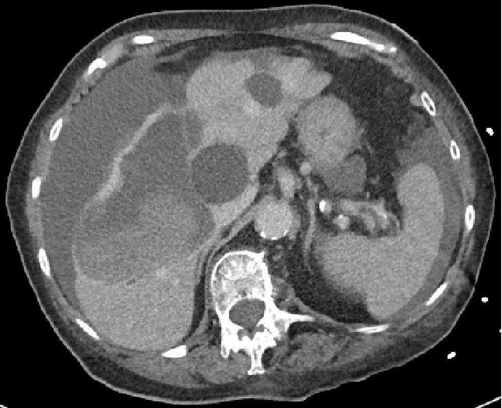 Nattokinase-Associated Hemoperitoneum in an Elderly Woman | Cureus