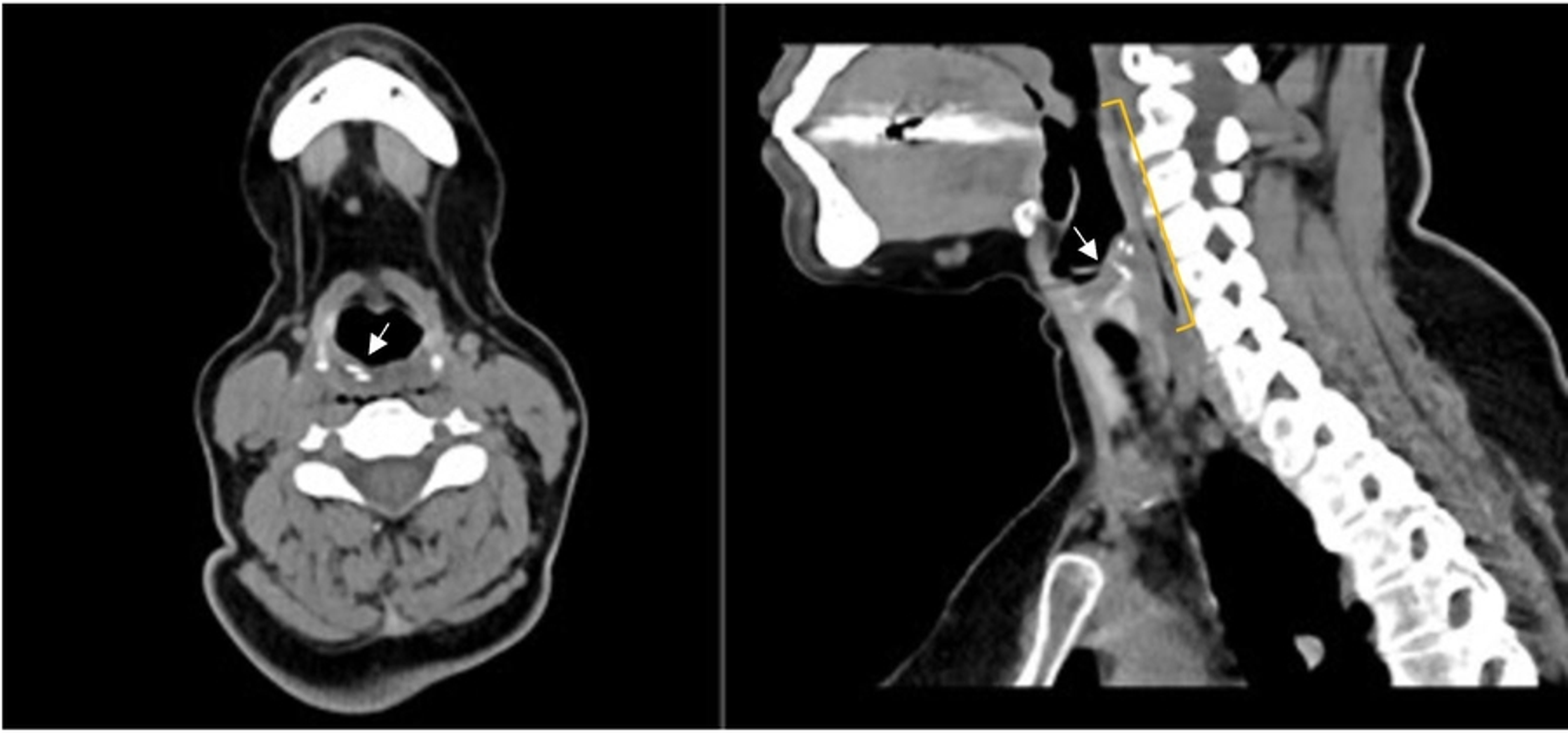 Cureus | Hypopharyngeal Perforation Following Foreign Body Ingestion: A ...