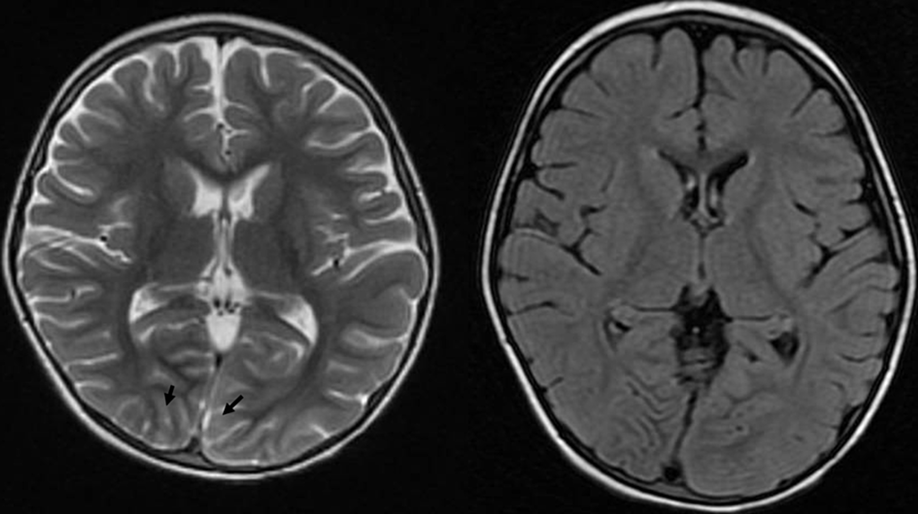 Cureus | Transient Cortical Blindness in a Toddler With Heterozygous ...