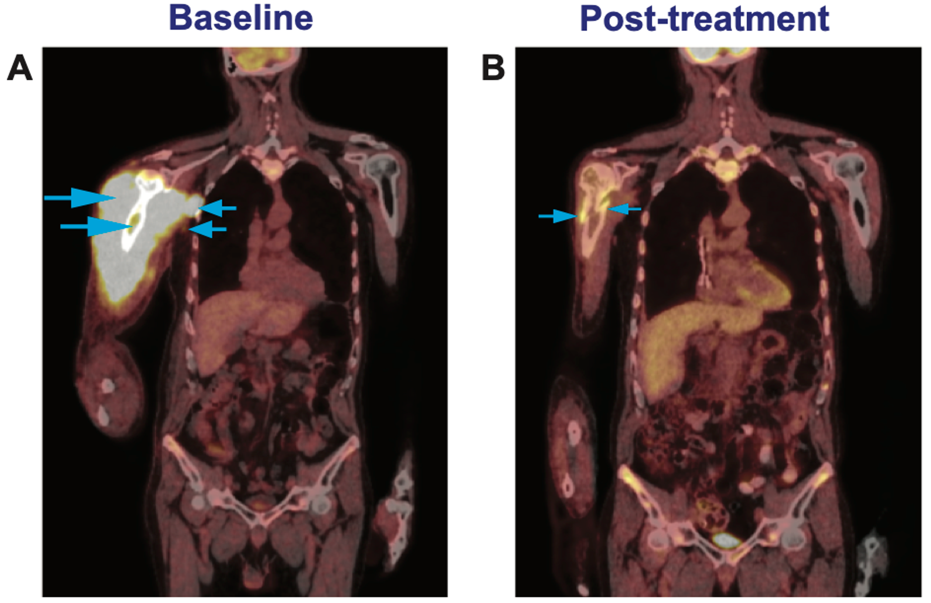 Cureus | Extranodal Diffuse Large B-Cell Lymphoma Of Bone And Soft ...