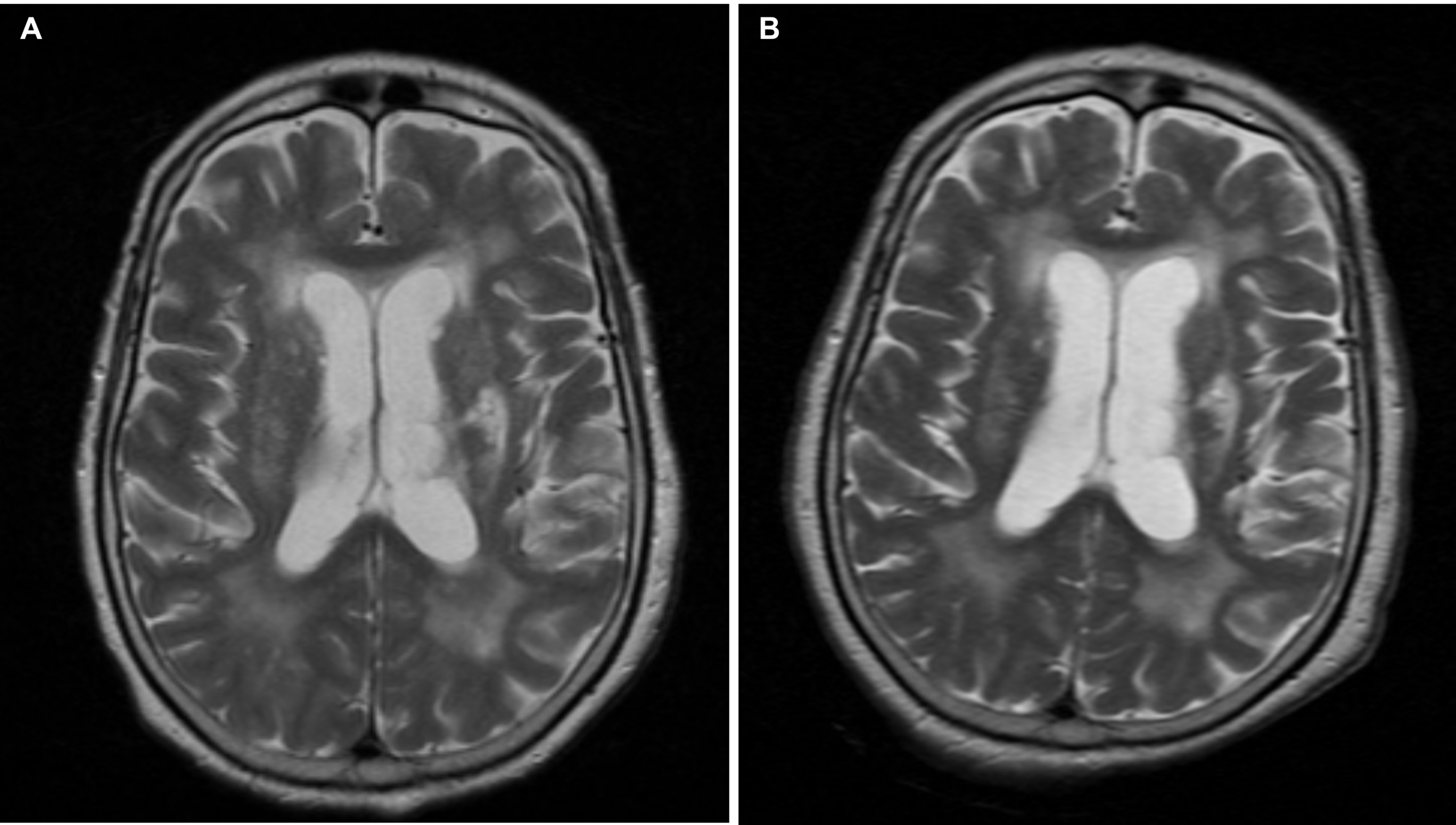 Cureus | Fat Embolism Syndrome With Cerebral Involvement: An ...