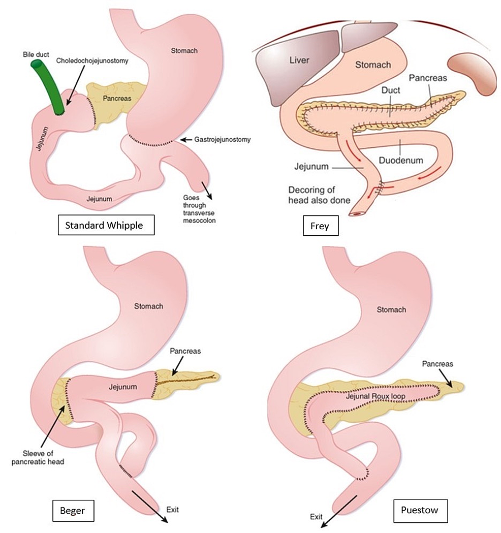 whipple procedure for pancreatitis