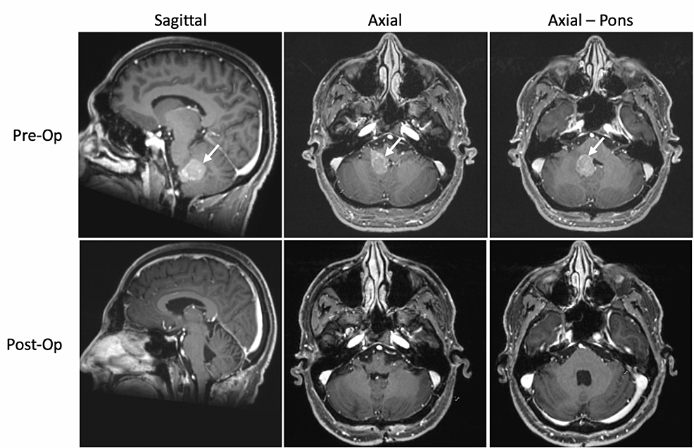 Pre--and-postoperative-T1-weighted-gadolinium-enhanced-MRI-images-in-sagittal-and-axial-planes.