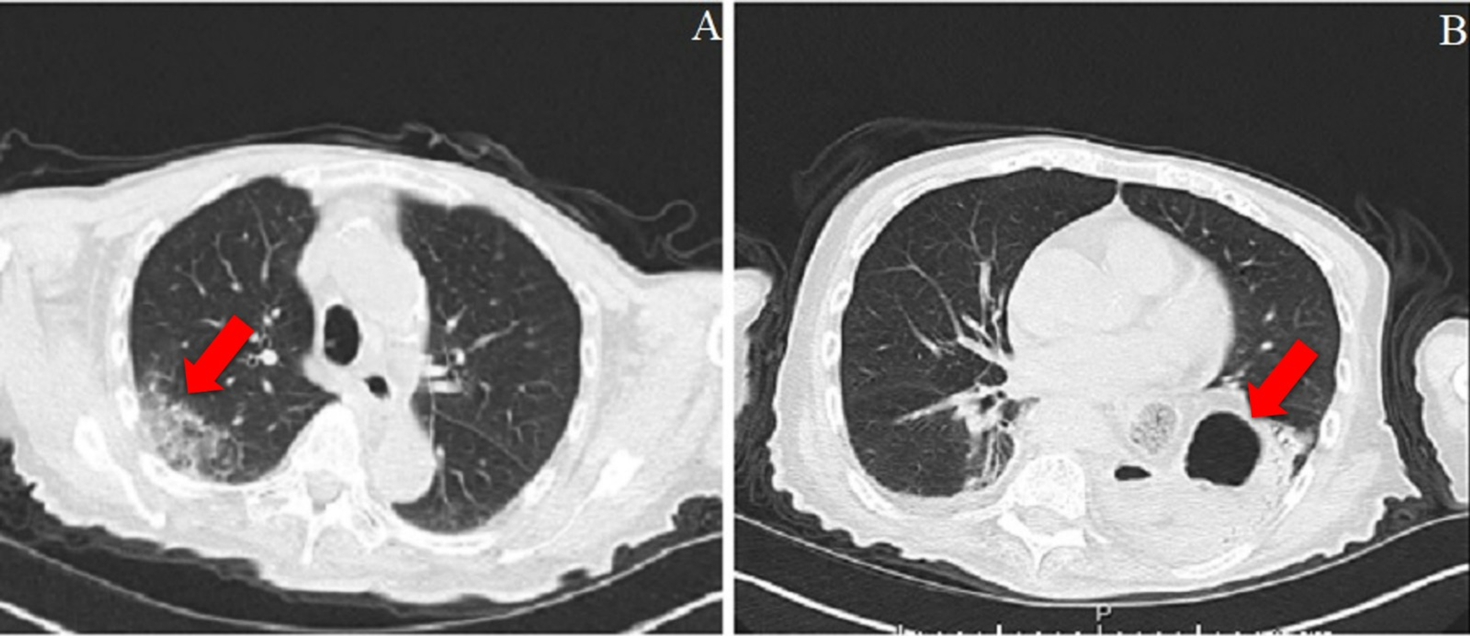 Cureus | Postmortem Biopsies Of The Lung, Heart, Liver, And Spleen Of ...