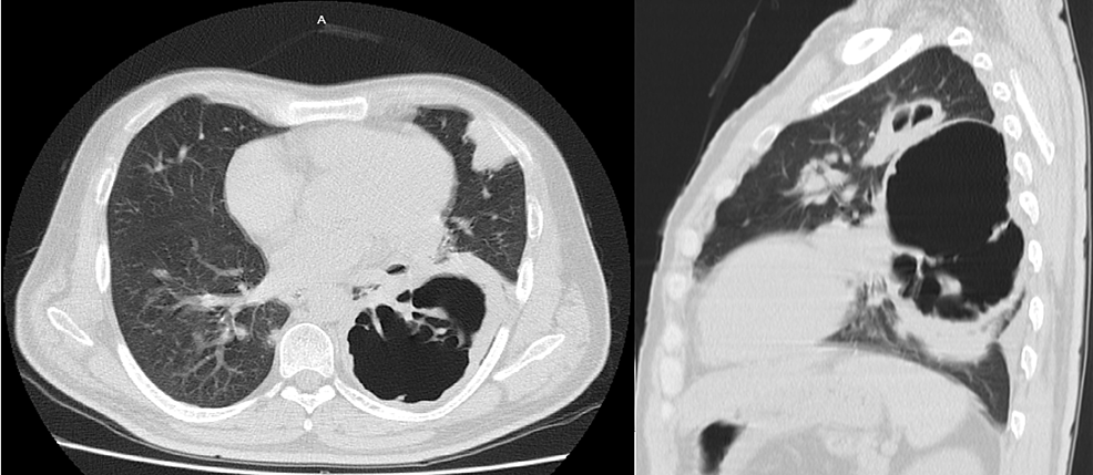 Massive Cavitation by Pneumocystis jirovecii in an Immunocompromised ...