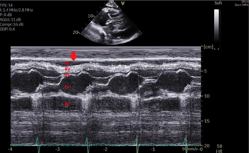 Cureus Transthoracic Mmode Echocardiography Demonstrating Cardiac